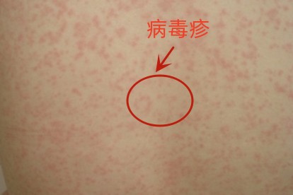 幼儿急疹与病毒疹区别图片 | 百度健康·医学科普