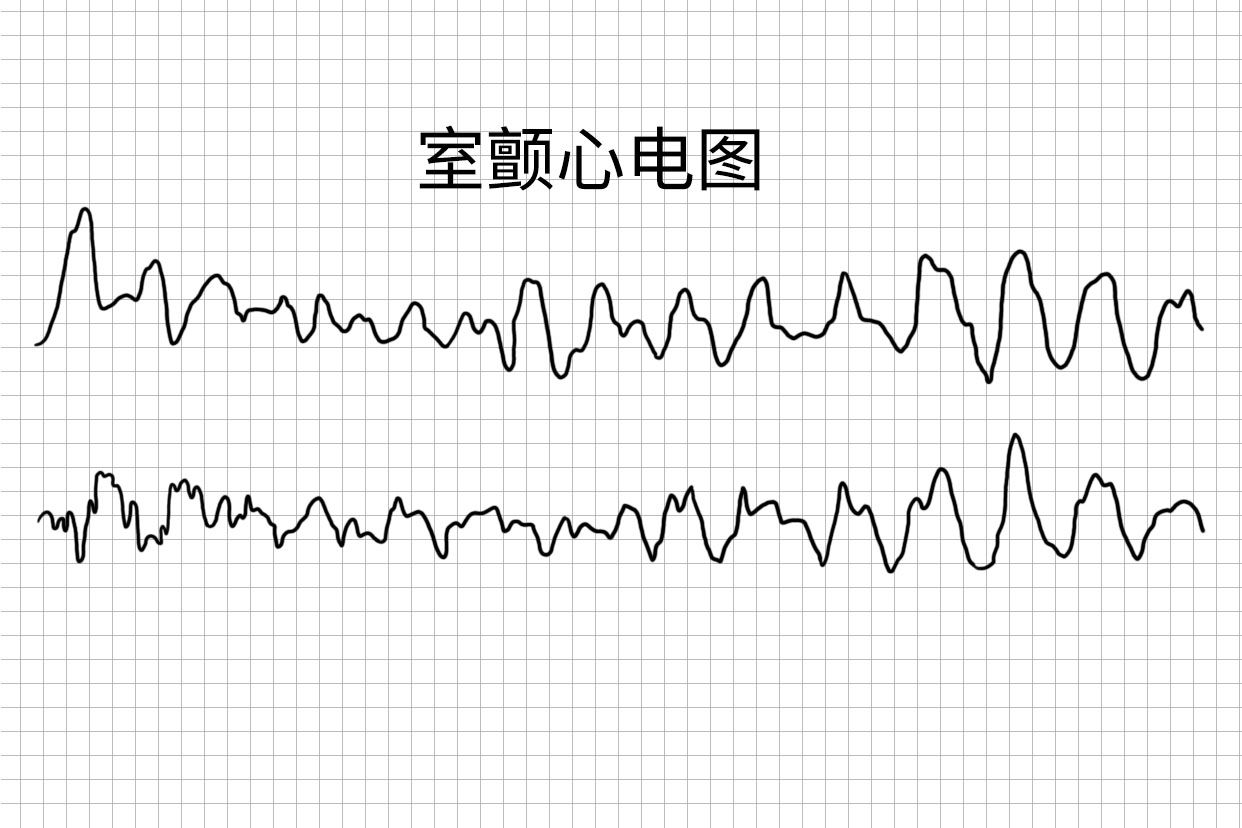 室颤心电图图片