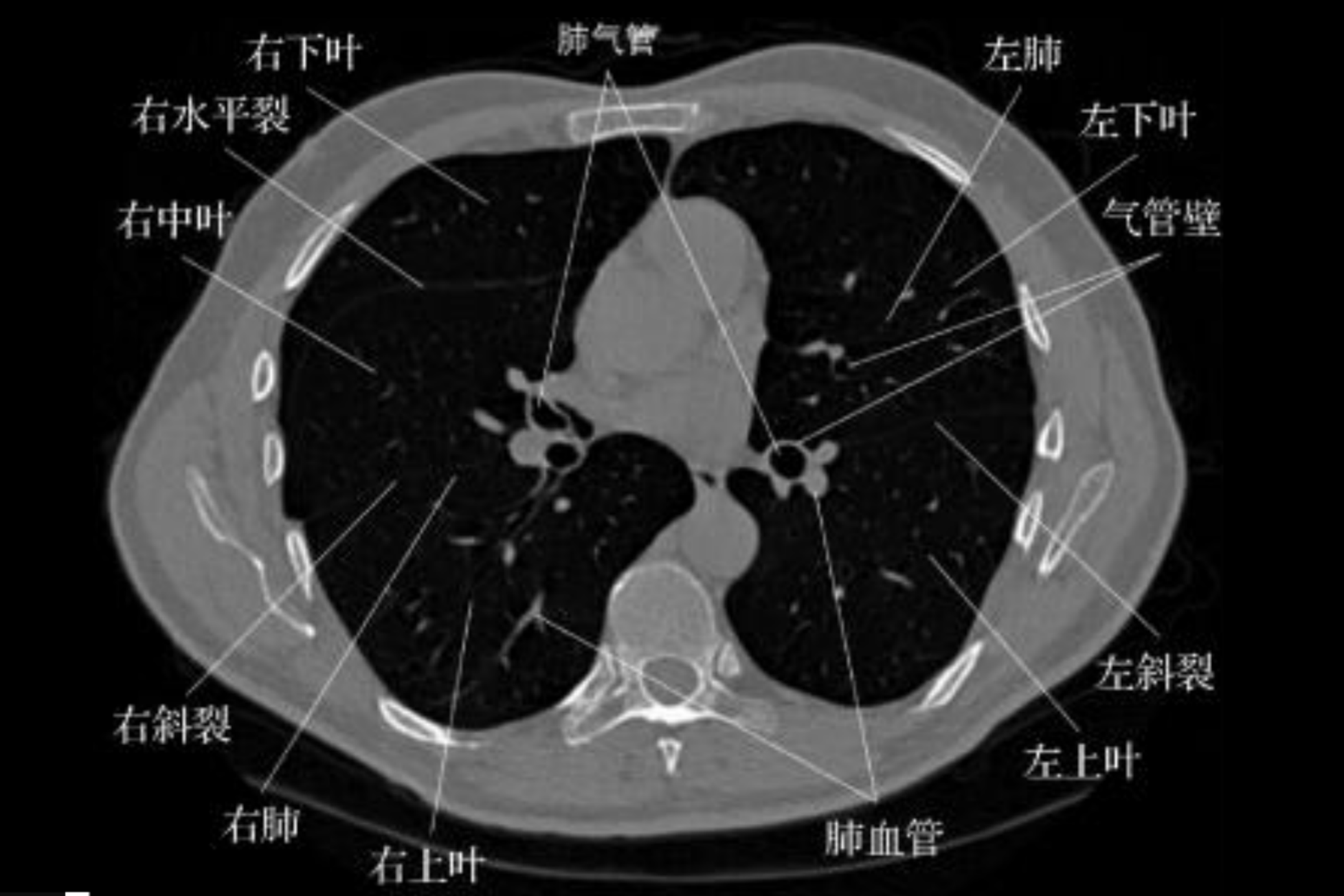 肺的ct图片怎么看 | 百度健康·医学科普