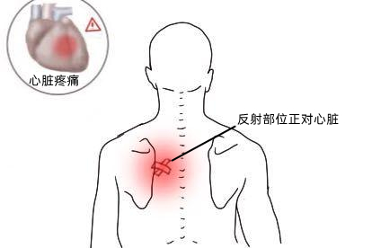 心脏后面后背疼痛位置图详解 | 百度健康·医学科普