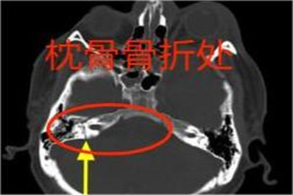 枕骨骨折的CT图片