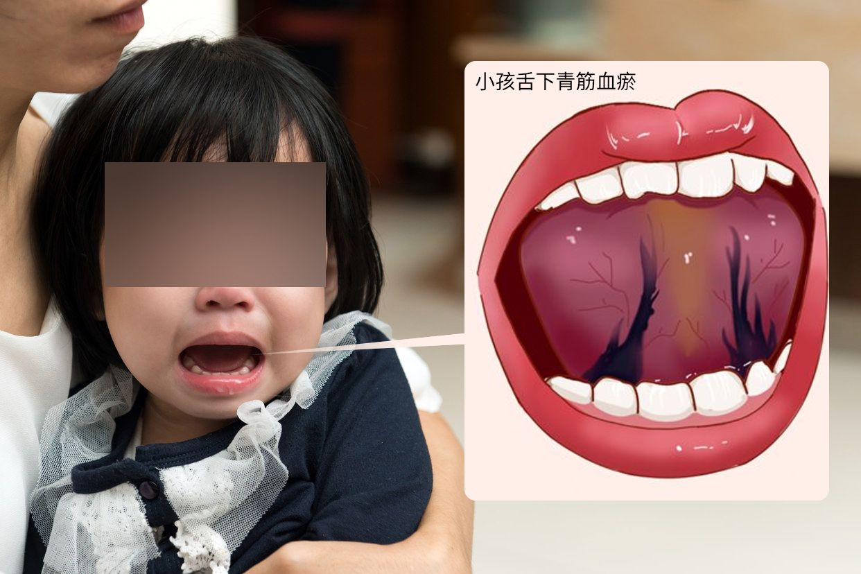 儿童舌下青筋血瘀图片 | 百度健康·医学科普