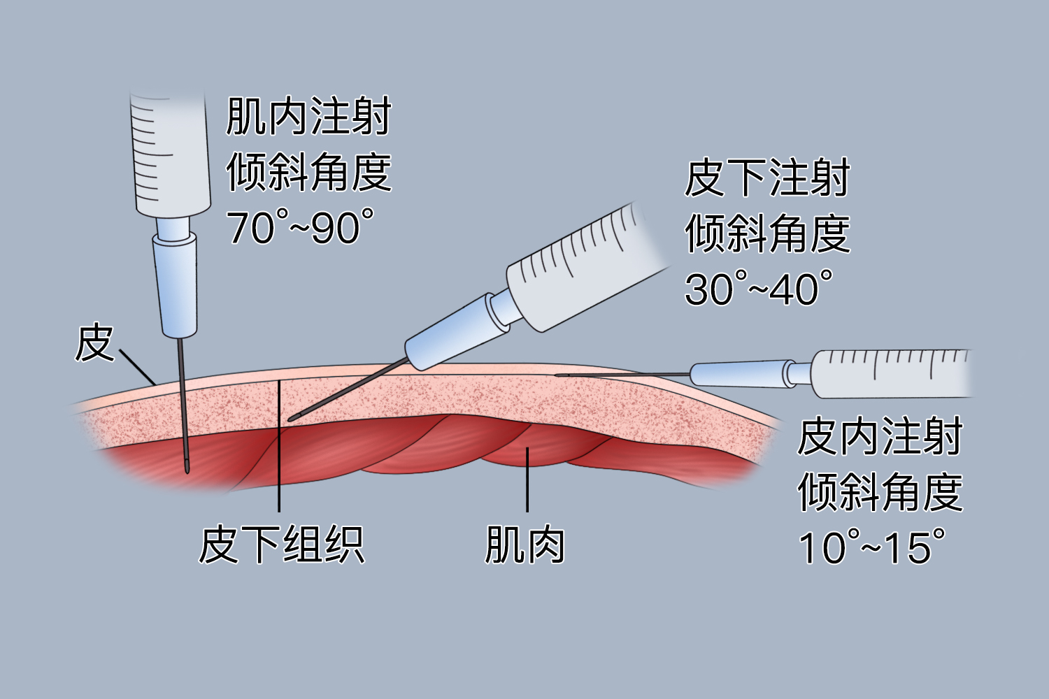 疫苗注射部位及进针角度图片