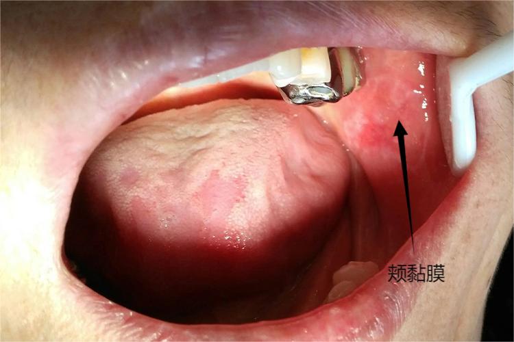 左侧口腔颊黏膜位置图