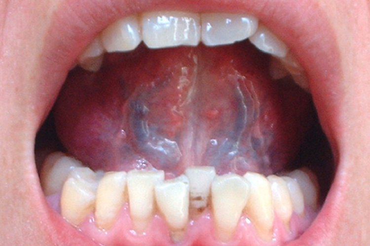 舌下青筋血瘀图