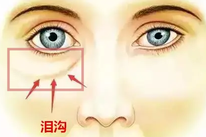 脸上泪沟图片 | 百度健康·医学科普