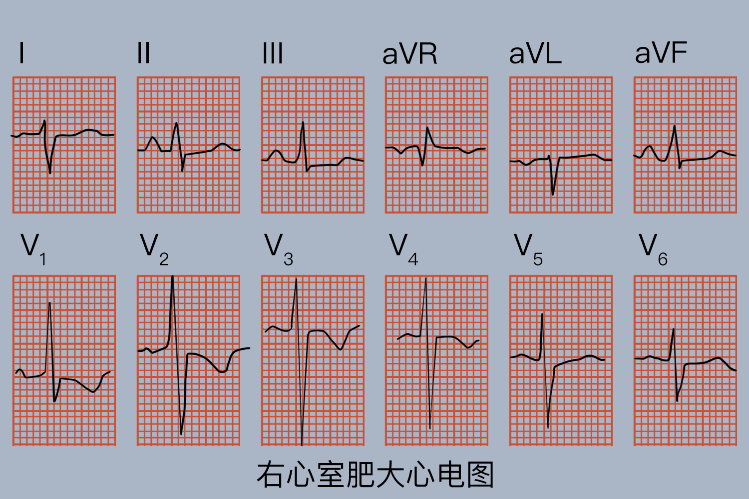 心电图上右心室肥大 百度健康·医学科普 