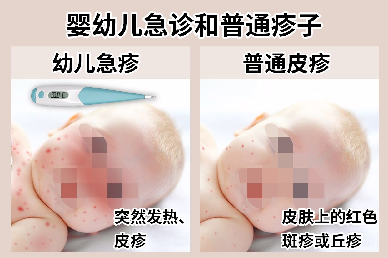 婴幼儿急疹和普通疹子图片