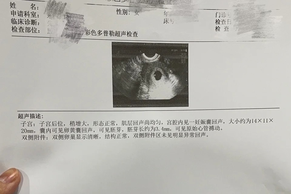 孕囊大小图