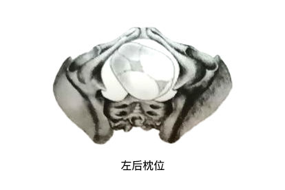 左枕后位是什么位置示意图 | 百度健康·医学科普