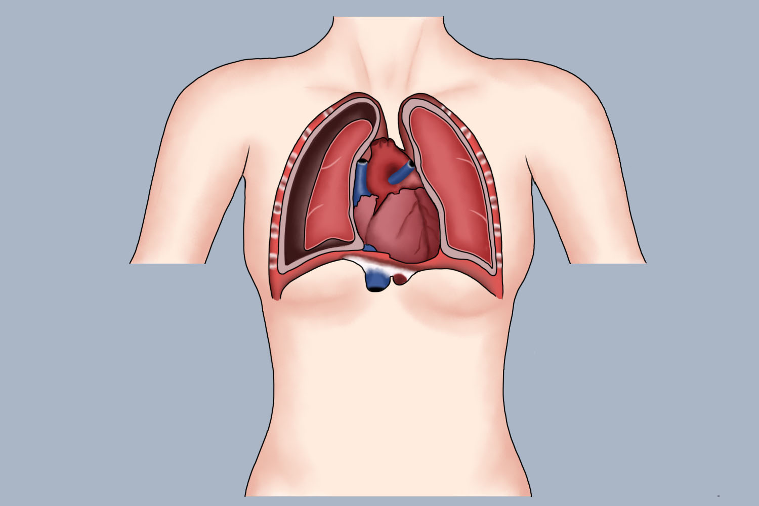 自发性气胸肺疼位置图