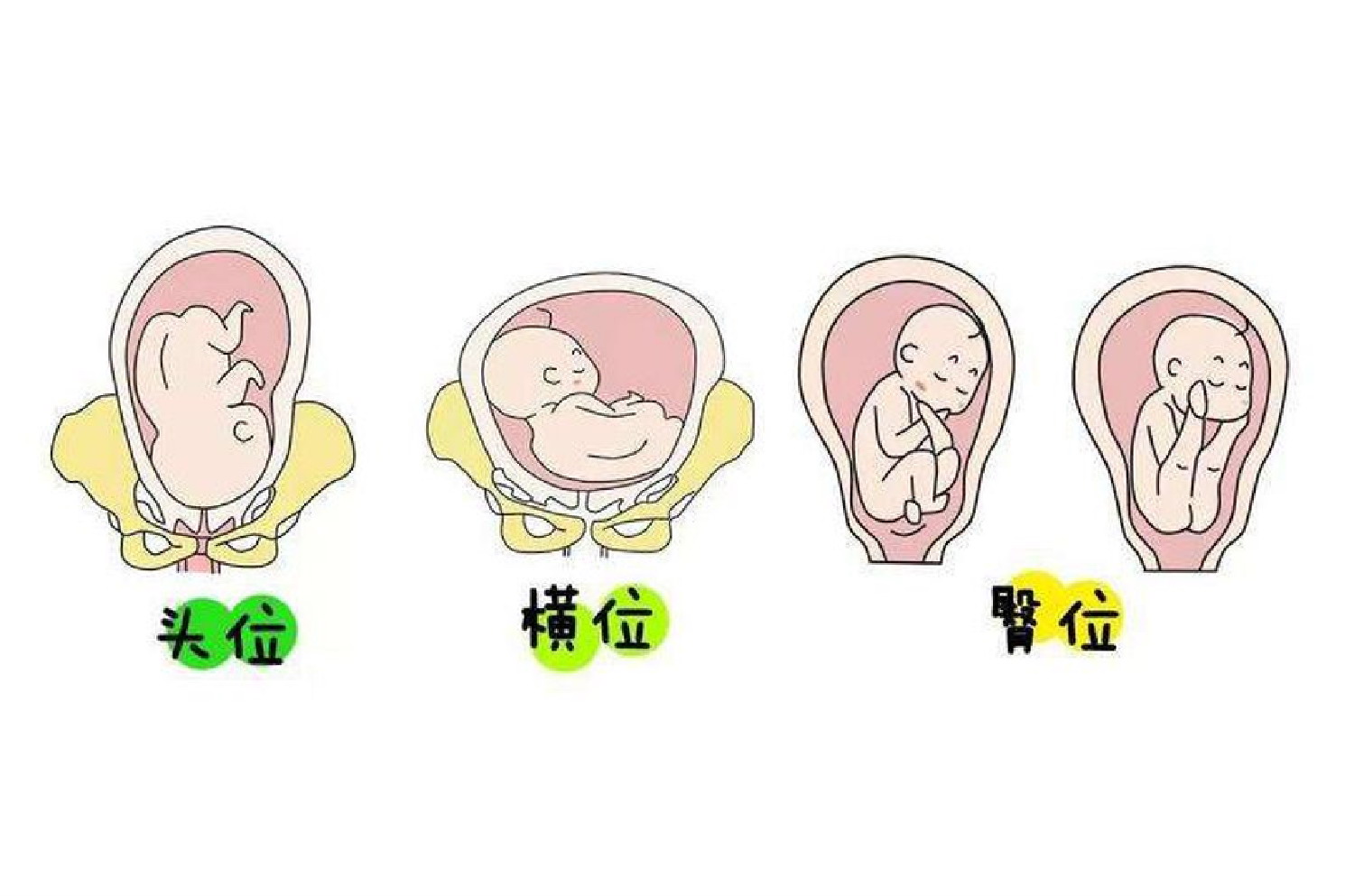 横位胎儿图 | 百度健康·医学科普