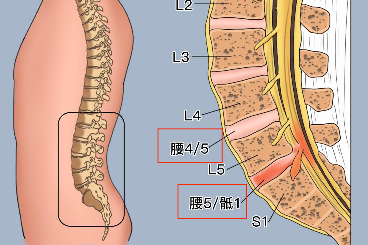腰4/5和腰5/骶1椎间位置图