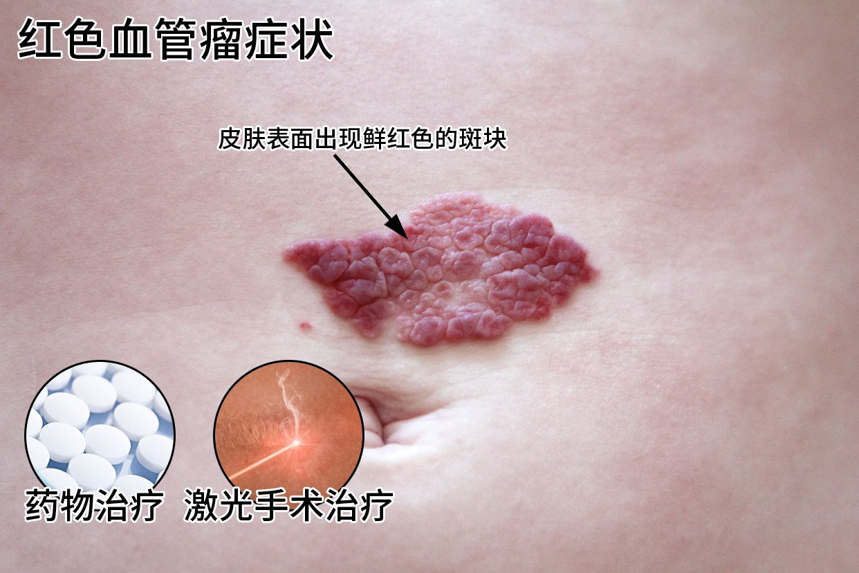 红色血管瘤是什么样的图片 | 百度健康·医学科普