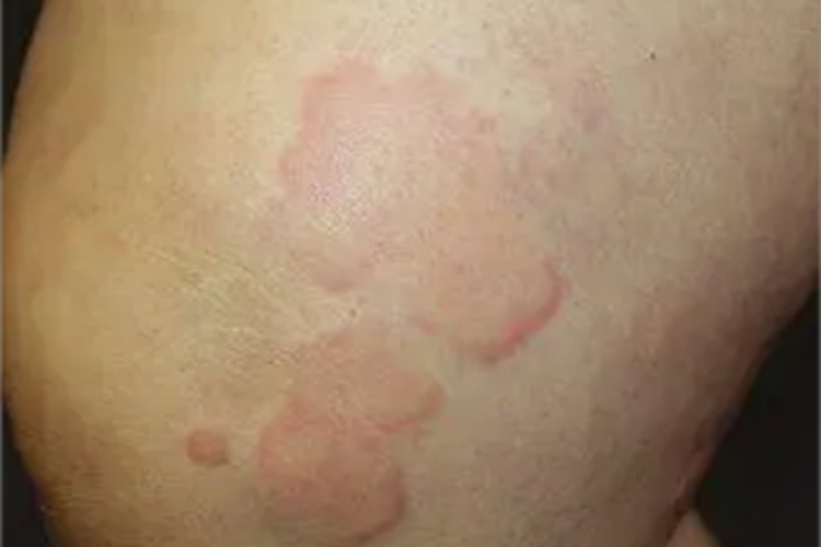 胆碱能性荨麻疹风团图片