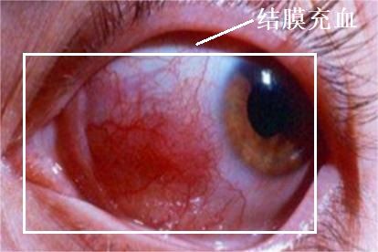 结膜充血和睫状充血示意图区别 | 百度健康·医学科普