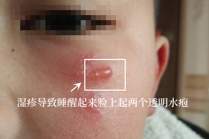 湿疹引起的透明水疱