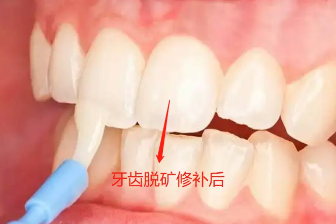 牙齿脱矿早期及补救图片