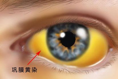 梗阻性黄疸图片