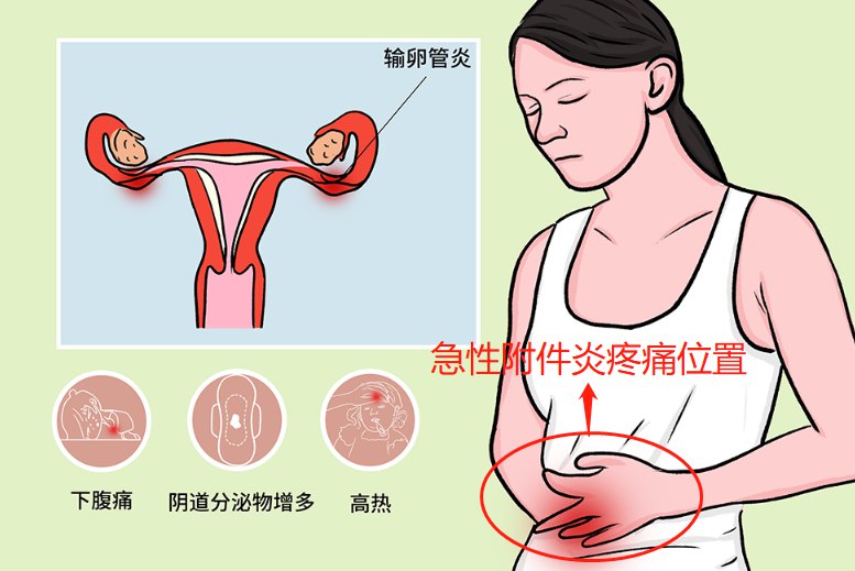 女性急性附件炎疼痛位置图