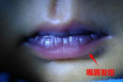 心脏病皮肤症状图片
