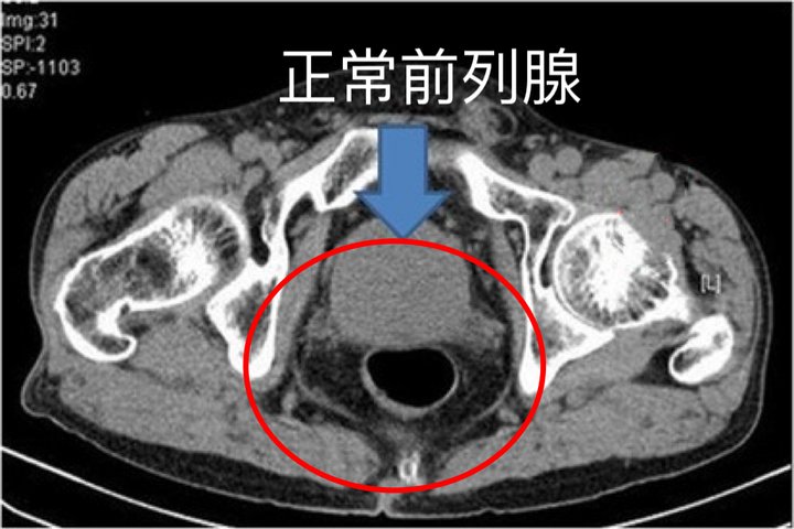 前列腺ct图片 | 百度健康·医学科普