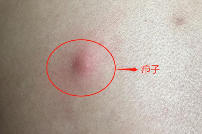 痈肿疮疖大疙瘩的图片