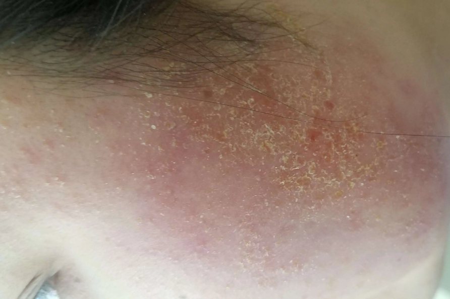 脂溢性皮炎脸部图片和症状 | 百度健康·医学科普