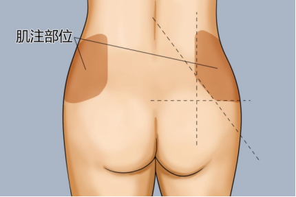 臀大肌十字法定位图