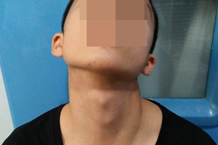 痉挛性斜颈后仰型症状图片