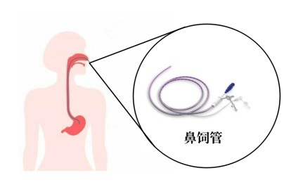 鼻饲管示意图