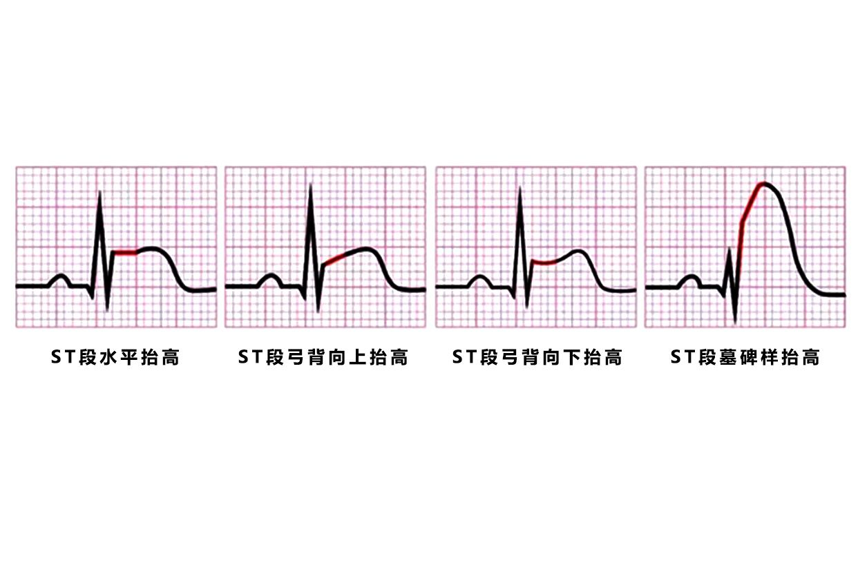 st段抬高型心电图图片 | 百度健康·医学科普