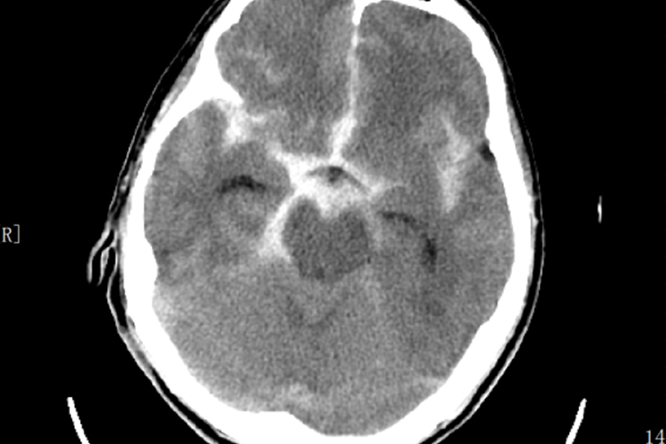 蛛网膜下腔出血CT图