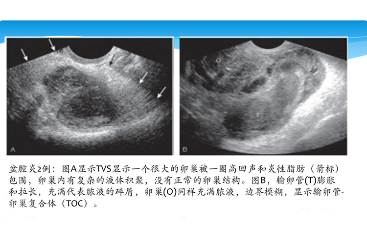 女性盆腔炎炎症图片 | 百度健康·医学科普