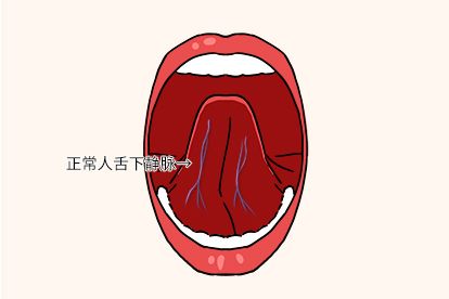 正常的舌下脉络图片 | 百度健康·医学科普