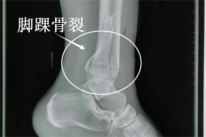 脚踝骨裂ct图片 | 百度健康·医学科普