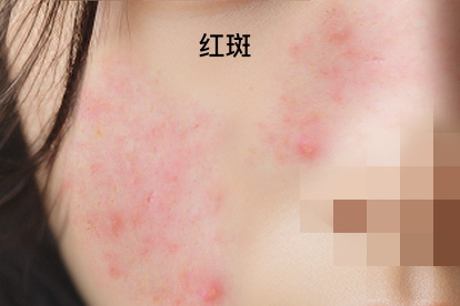皮肤过敏的10种症状图片