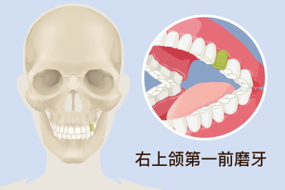 右上颌第一前磨牙描绘图