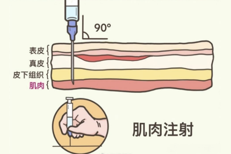 皮下皮内肌内注射的区别 | 百度健康·医学科普
