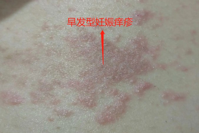 孕妇肚子出现红疹痒图