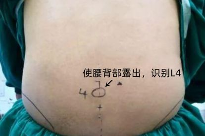 腰麻侧入路图解 | 百度健康·医学科普
