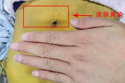 梗阻性黄疸图片