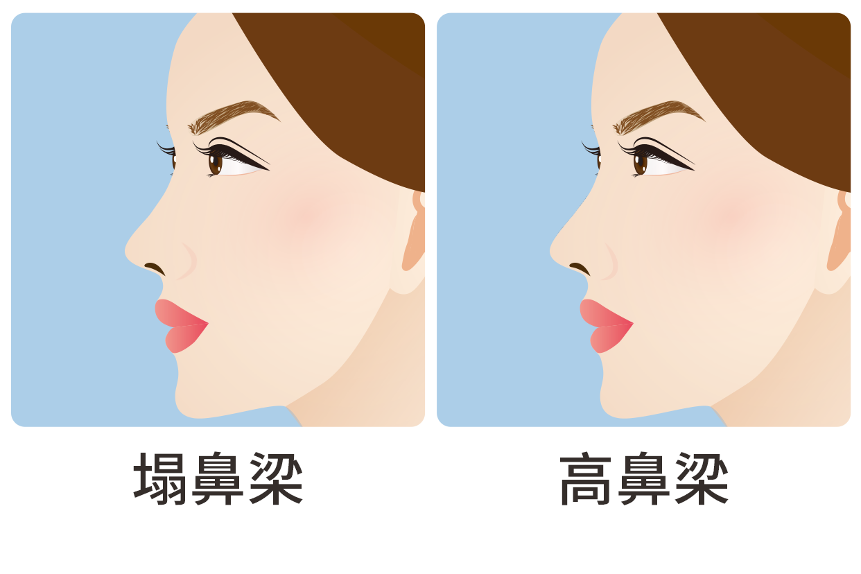高鼻梁和塌鼻梁区别图 | 百度健康·医学科普