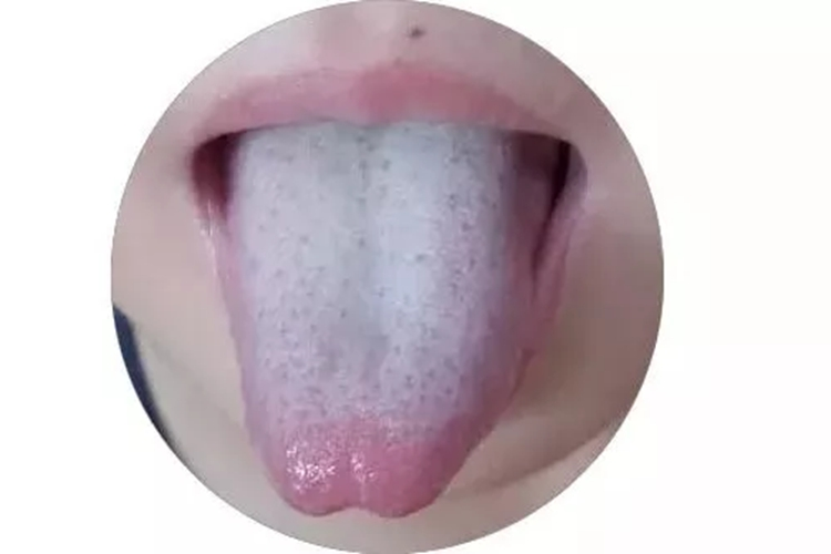 苔厚者舌苔图