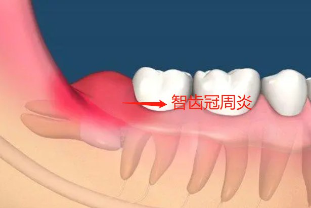 智齿发炎图片