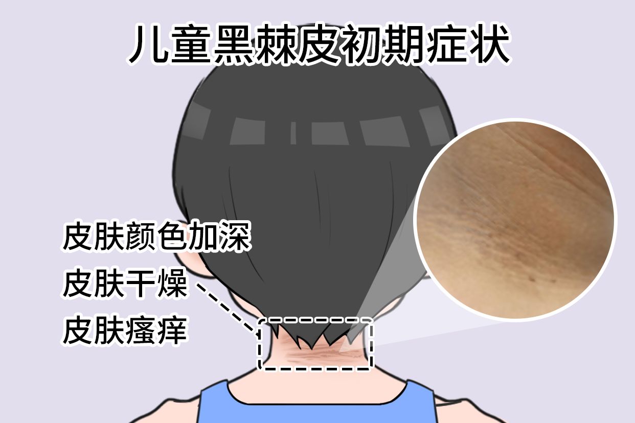 儿童黑棘皮初期图症状 | 百度健康·医学科普