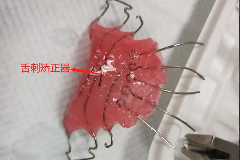 舌刺矫正器图片 | 百度健康·医学科普