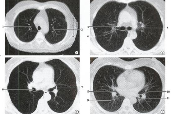 肺部CT正常图