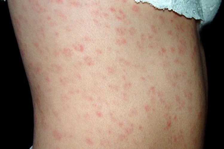 水痘和疹子的区别图片 | 百度健康·医学科普