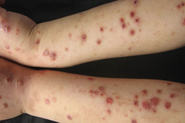 结节性痒疹胳膊症状图片